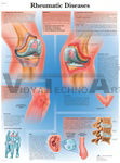 Rheumatic Diseases - Anatomical Chart